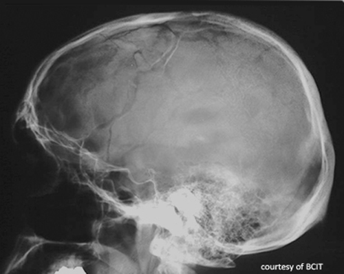 <p>Thin lines without splintering or depression; may be longitudinal or transverse; caused by low-impact blunt trauma.</p>