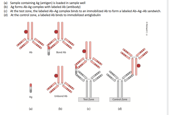 <p>Simple and rapid, often used for screening tests. Consists of a dye labelled monoclonal antibody in a sample well and a polyclonal antibody immobilized on a nitrocellulose membrane. When sample is loaded into the well, antigen forms Ag-Ab complex with the antibody. The complex diffuses to reach the test zone where immobilized antibody traps complex to form antibody-antigen-antibody sandwich.</p>