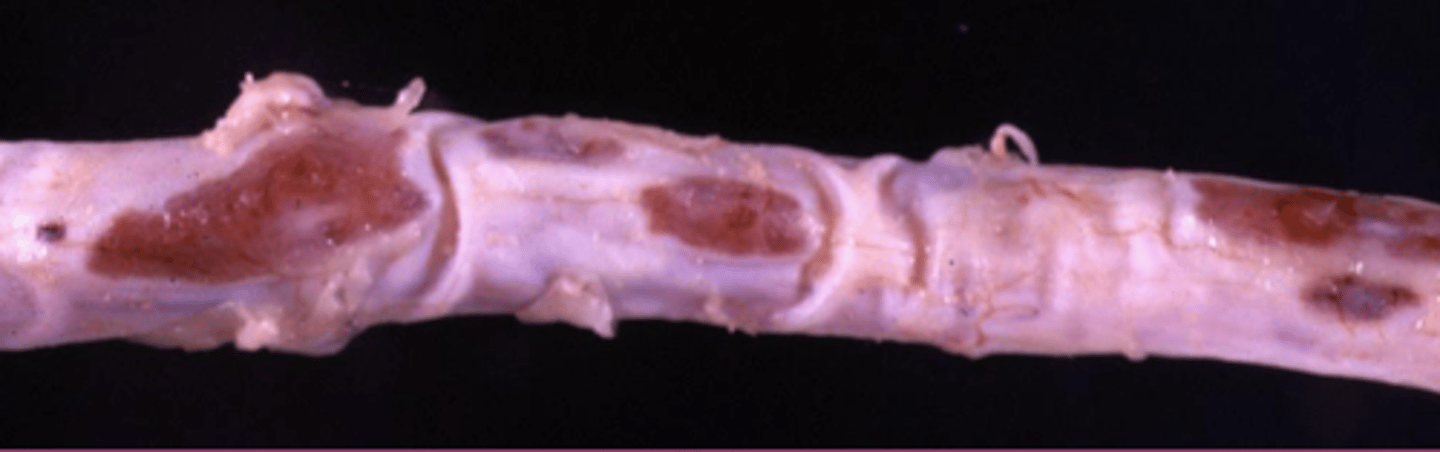 <p>What is this extracellular accumulation of the dura mater?</p>