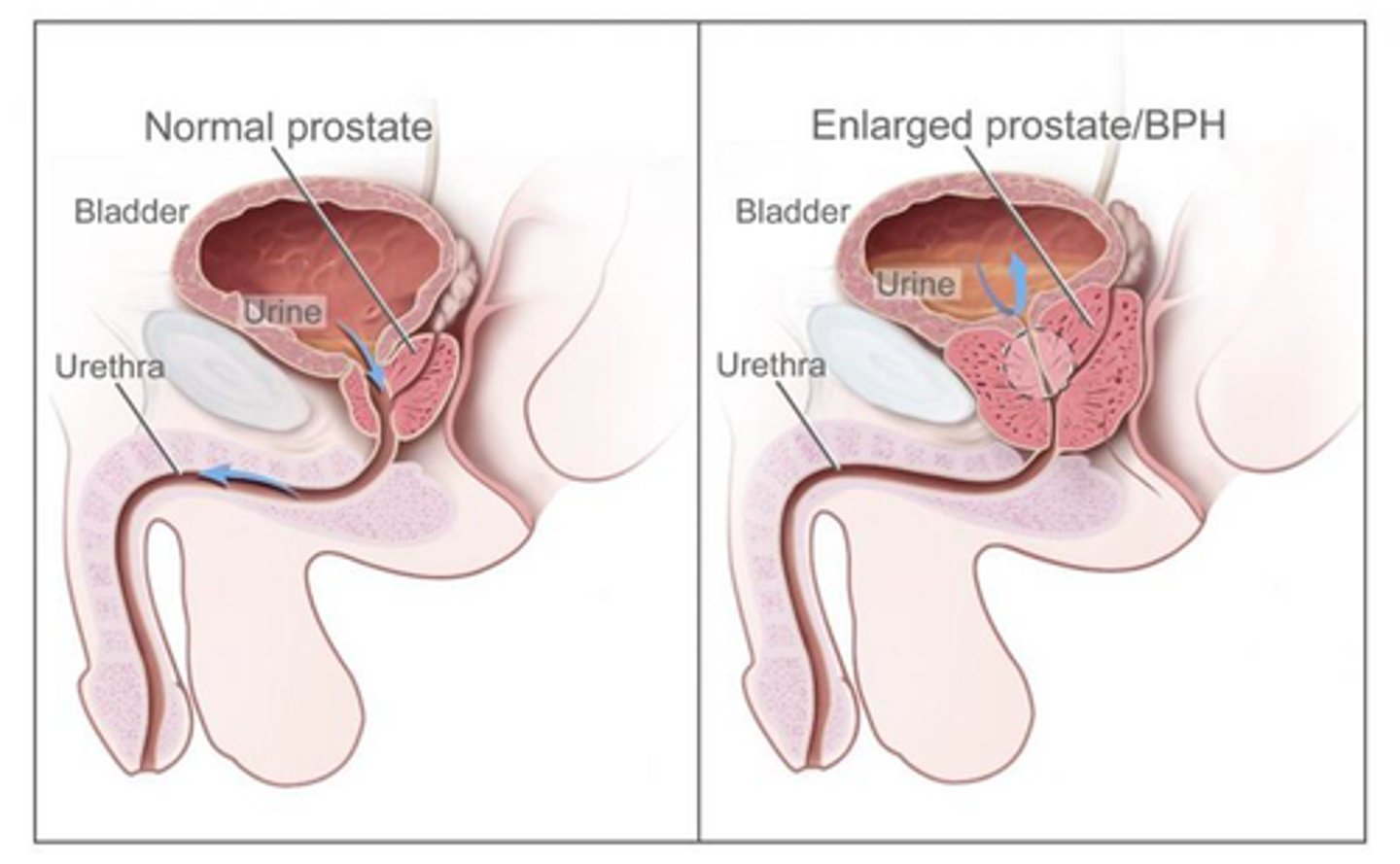 <p>enlargement of the prostate</p>