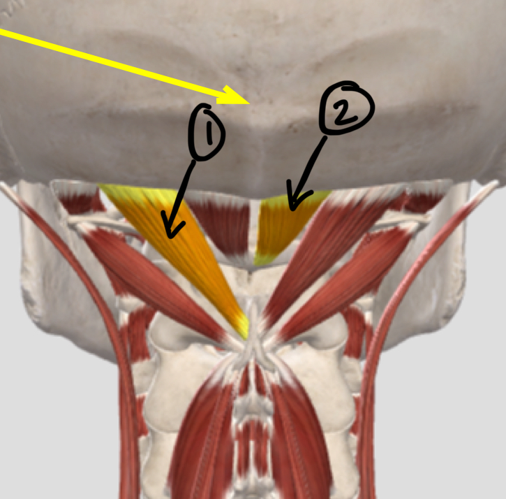 <p>What mm are these?</p><p>O, I, A bilateral and unilateral, N</p>