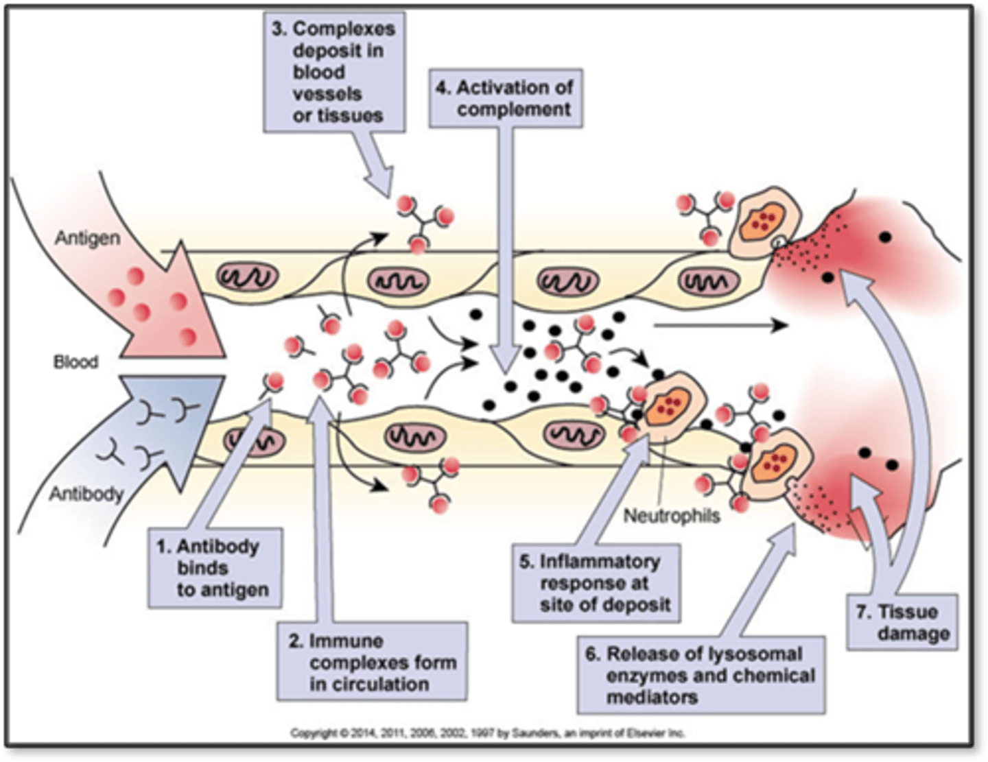 <p>- Immune complex hypersensitivity</p><p>- Antigen-antibody complexes deposit in tissue</p><p>- Complement system activated, inflammation occurs</p><p>- Immune system becomes confused</p><p>- Maybe failure of regulatory T cells</p><p>- Can attack heart muscle, can deposit into kidneys, renal failure after strep</p><p>- Heart, kidneys, joints, blood vessels</p><p>- Effects: Inflammation, increased vascular permeability</p>