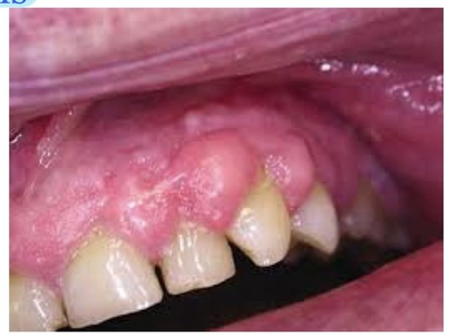 <p>This can be caused by anti convulsants (Phenytoin), cardiovascular drugs (Nifedipine), and immunosuppressants (Cyclospirin). Adequate plaque control, reduction of magnitude of ————— ————————, starting a regime before the meds are all important when the patient has this.</p>