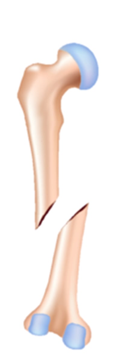 <p>Bone ends are out of alignment</p>