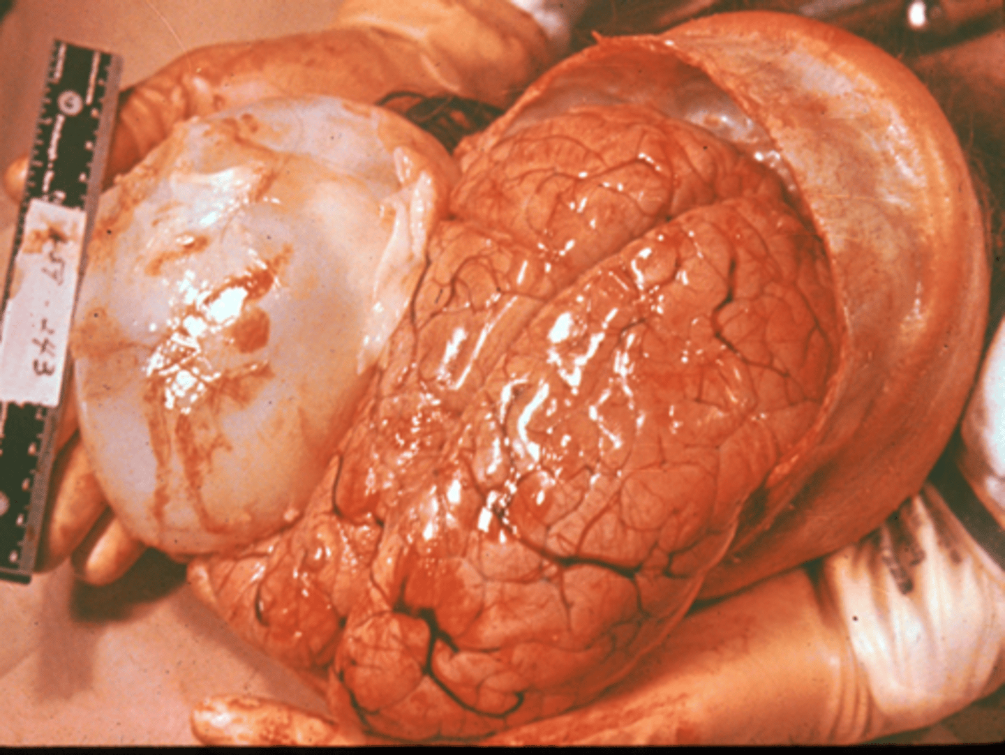 <p>How do people and other mammalian intermediate hosts acquire the disease hydatidosis produced by the parasite Echinococcus granulosis?</p>