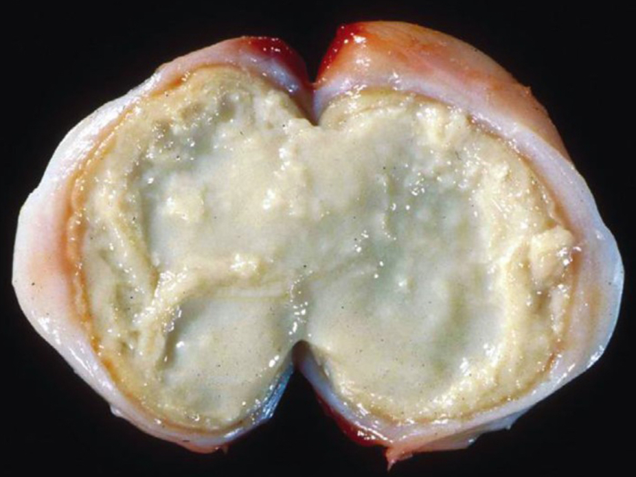 <p>What are two common differential diagnoses of this type of necrosis?</p>