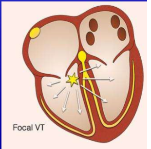 <p>ectopic cells in the ventricle</p>