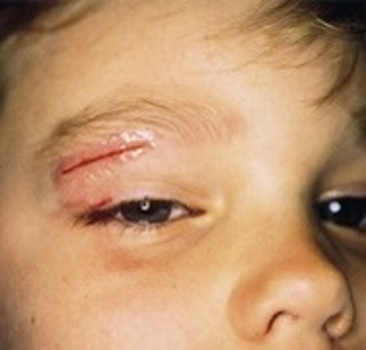<p>for lacerations in low stress areas</p>