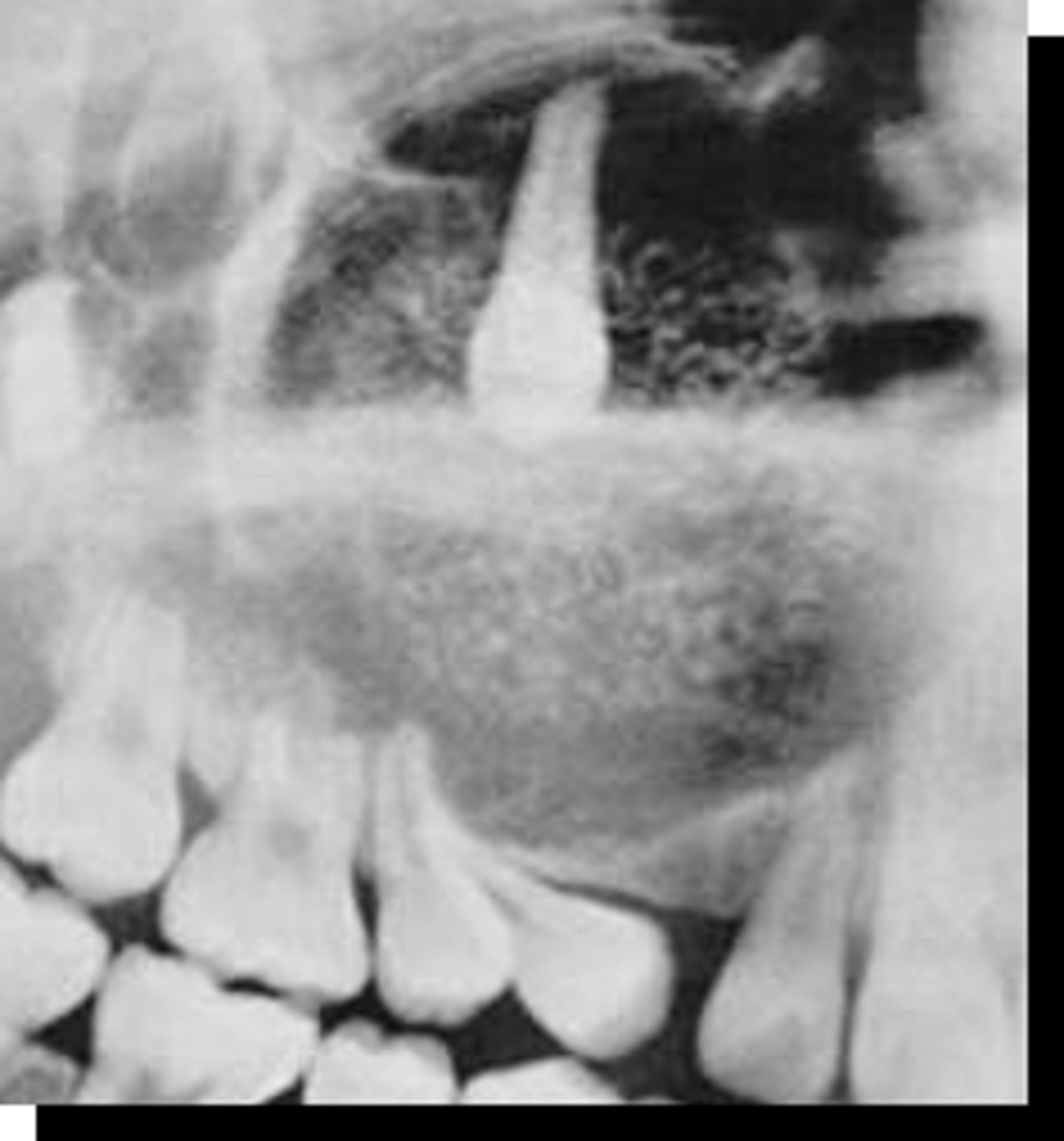 <p>20 y/o patient presents with well circumscribed, corticated unilocular lesion on the anterior maxilla that surrounds the entire tooth #6, with mixed radiopacities around the crown of the tooth. The roots of the surrounding teeth are displaced.</p><p>What is the diagnosis?</p>