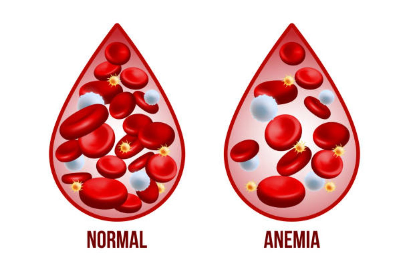 <p>Anemia</p>