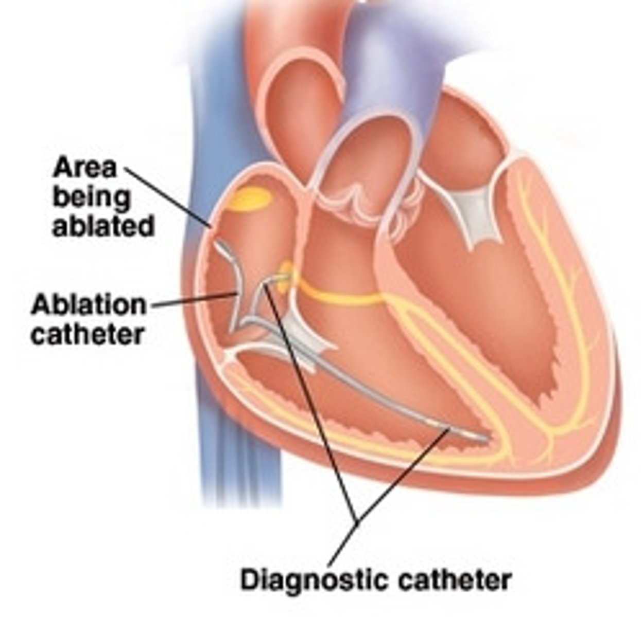 <p>-medical procedure that destroys all small areas of the heart that are emitting dangerous signals causing abnormal contractions</p><p>-small catheters are threaded through a vein to the heart</p><p>-the dysfunctional cardiac tissue is reached and an electrical impulse is sent to the site, destroying the abnormal tissue</p>