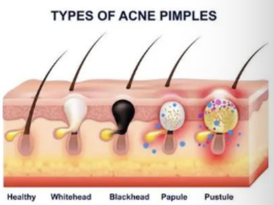 <p>Widespread inflammatory papules, pustules, nodules or cysts. Scarring may be present.</p>