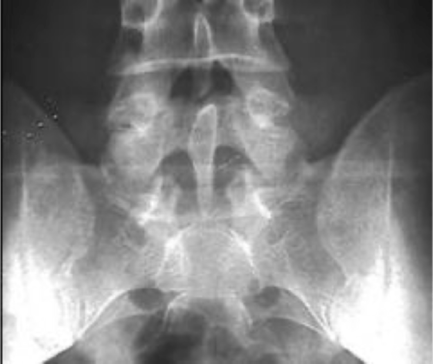 <p>Clasp-Knife clinical significance</p>