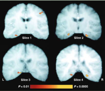 <p>-<span>able to measure the BOLD signal associated with individual rapidly occurring neural events</span></p><p><span>-Which areas of brain show increased activation when one is viewing a picture</span><br><span>that is subsequently well remembered vs. one that is simply judged familiar or not remembered at all?</span></p><p><span>-study done in fMRI scanner</span></p><p><span>-Parahippocampus and the right dorsolateral prefrontal cortex correlated with levels of memory performance for individual events</span></p>
