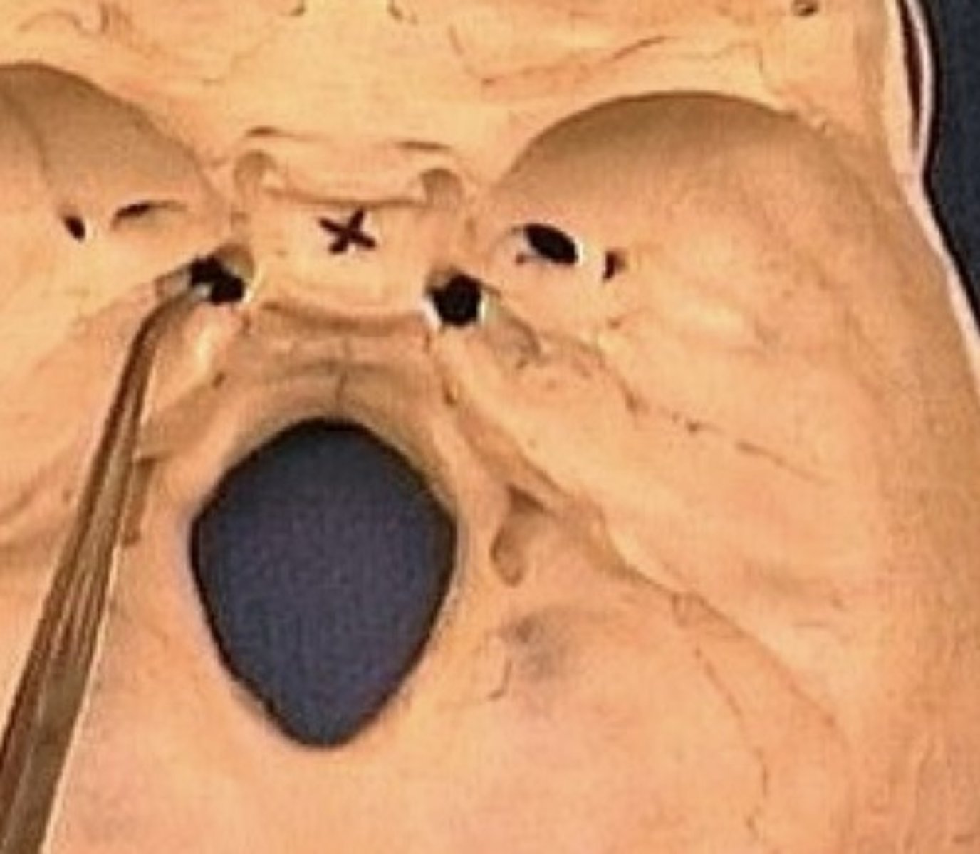 <p>1. Appears lacerated (jagged edge)</p><p>2. Not a true foramen</p><p>3. Formed between sphenoid and temporal bone</p>