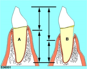 <p>The ratio of the length of the part of the tooth that appears superior to the alveolar process versus what is inferior to it.</p>