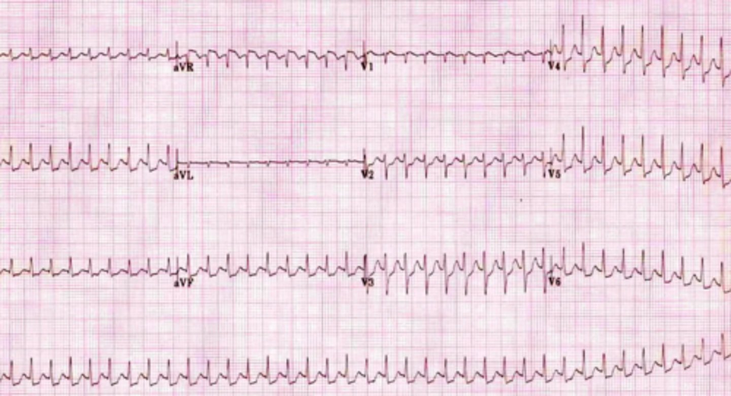 <p>What is the rhythm</p>