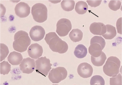 <p>What does this refer to</p><ul><li><p>RBCs with nuclear remnants (Howell-Jolly bodies) = asplenia</p></li><li><p>Spherical or ovoid eccentrically located granules occasionally observed in the stroma of circulating erythrocytes that occur most frequently after splenectomy or in megaloblastic or severe hemolytic anemia</p></li></ul><p></p>
