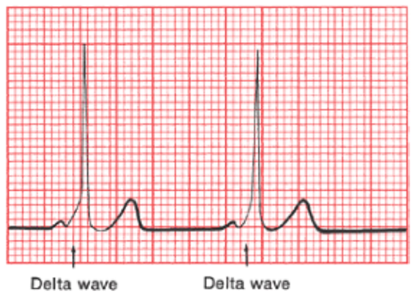 <p>- Delta wave—slurred initial portion of the QRS</p><p>- Represent AV node conduction via accessory pathway—bundle of Kent</p><p>- Palpitations secondary to AV re-entrant tachycardia</p>