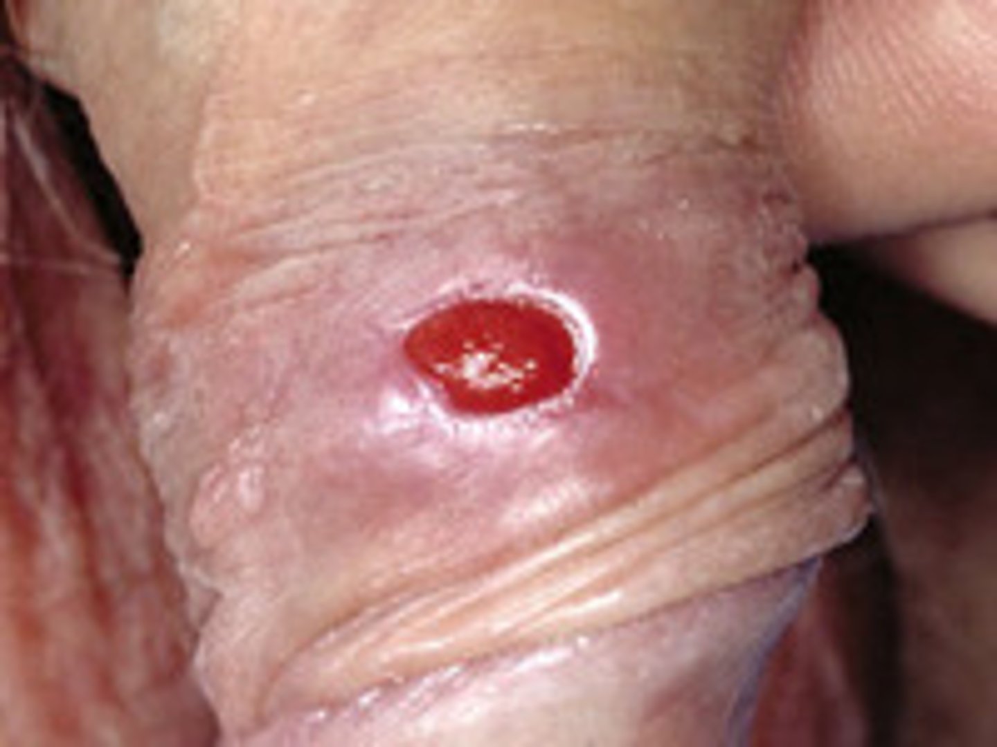 <p>Small, round, painless ulcerated sore. </p><p>Usually of the genital area, but can also be found on the mouth or anus.</p><p>Associated with primary syphilis infection.</p>