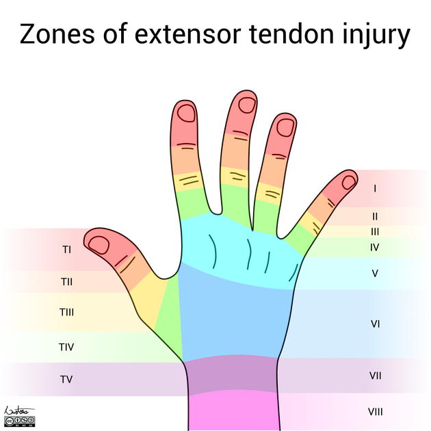<ul><li><p><strong>Week 1-3</strong></p><ul><li><p>Orthotic - hand based TH spica with CMC in slight palmer abduction, radial extension, <strong><em>IP and MP at 0 degrees</em></strong></p></li><li><p>Edema management</p></li><li><p>Wound care/ scar management</p></li></ul></li><li><p><strong>Week 3</strong></p><ul><li><p>Begin <strong><em>25-30 degrees</em></strong> combined AROM of IP/MP jt flexion</p></li><li><p>AROM opposition to IF</p></li><li><p>Orthotic use between exercise sessions</p></li><li><p>Scar management</p></li></ul></li><li><p><strong>Week 4</strong></p><ul><li><p>Advance patient to <strong><em>45-50 degrees </em></strong>of combined AROM of IP/MP jt flexion - <em>advance pt by 20 degrees</em></p></li><li><p>AROM opposition to LF</p></li><li><p>Orthotic use between exercise sessions</p></li><li><p>Scar management</p></li></ul></li><li><p><strong>Week 5</strong></p><ul><li><p>Advance patient to <strong><em>65-70 degrees </em></strong>of combined AROM of IP/MP jt flexion - <em>advance pt by 20 degrees</em></p></li><li><p>AROM opposition to RF</p></li><li><p>Orthotic use between exercise sessions</p></li><li><p>Scar management</p></li></ul></li><li><p><strong>Week 6</strong></p><ul><li><p>D/C orthosis</p></li><li><p>Advance patient to full flexion of IP/MP jts.</p></li><li><p>AROM opposition to SF and base of SF</p></li><li><p>Begin strengthening</p></li></ul></li></ul><p></p>