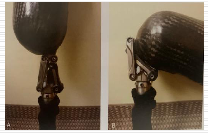<p>Polycentric Knees </p>