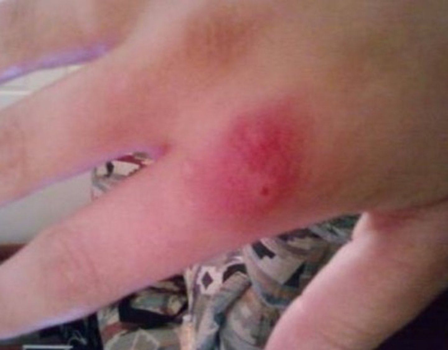 <p>Hx: target lesion after a "pinprick feeling"</p><p>induration, erythema, blistering</p>