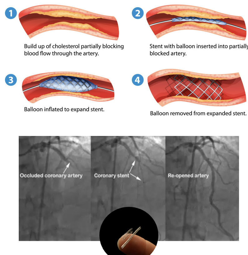 <p>A procedure that leaves a permanent wire mesh within a coronary artery to restore flow to cardiac tissue.</p>