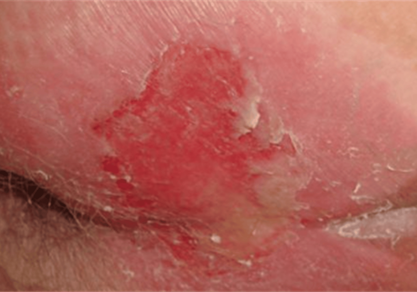 <p>loss of integrity (usually epidermis) often presenting with damaged, removed, or lost skin layer</p><p>- result from trauma</p><p>- often appear red, raw, moist</p><p>- may be confused with pressure ulcers (friction) or incontinence-associated dermatitis (secondary to body fluids)</p>