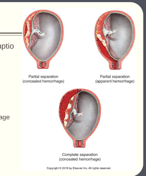 <p>§ Premature separation of placenta (abruptio placentae)</p><p>§ Can be marginal, partial or complete</p><p>§ Classification systems</p><p>§ Grades 1 (mild), 2 (moderate), 3 (severe)</p><p>§ With or without visible bleeding</p><p>§ Visible bleeding = apparent hemorrhage</p><p>§ Non-visible bleeding = concealed hemorrhage</p><p></p><p>§ Risks: Maternal hypertension, trauma, oxytocin administration</p><p>§ Pain? yes</p>