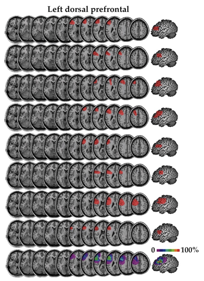 <p>Voxel-based lesion symptom mapping (VLSM)</p>