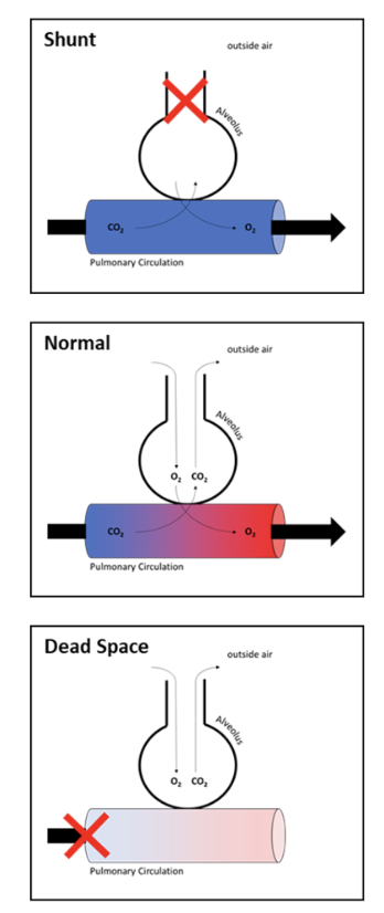 * gas exchange depends upon the relationship between ventilation (air in alveoli) + perfusion (blood flow through capillaries)

\
Va/Q = alveolar ventilation/ cardiac output