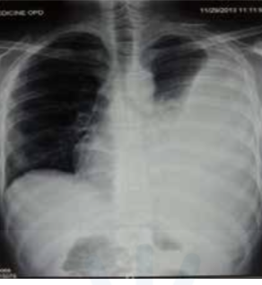 <p> Radiological diagnosis of pleural effusion</p>