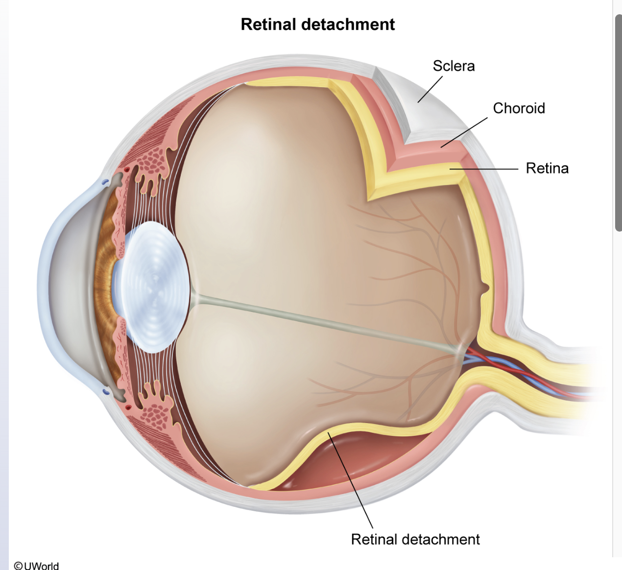<p>Retinal Detachment</p>