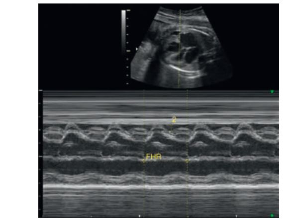 <p>Two-dimensional and M-mode image demonstrating</p>