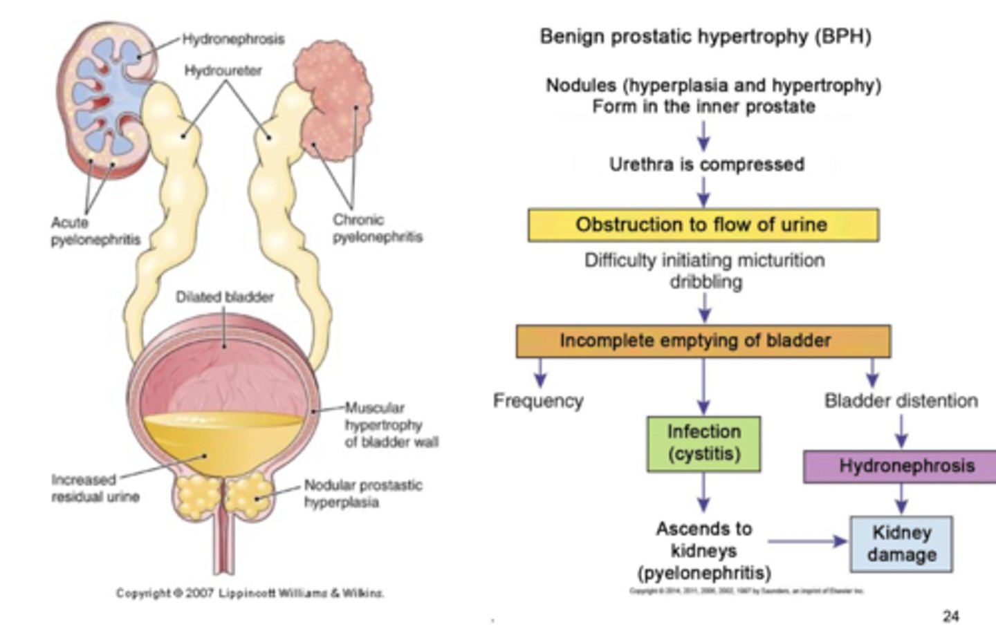 <p>occurs in half of older men.. compression of urethra and urinary obstruction.. estrogen-testosterone imbalance. no coma. typically a nonmalignant enlargement that is characterized by the formation of large, discrete lesions in periurethral region</p>