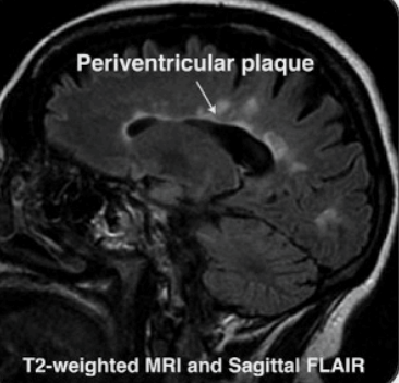 <ul><li><p>S/S: Demyelination of CNS —&gt; fatigue, sensory changes, muscle spasticity,<strong> optic neuritis (painful monocular vision loss) &amp; internuclear ophthalmoplegia (impaired horizontal eye movements)</strong></p></li><li><p>PE: Relative afferent pupillary defect/Marcus Finn pupil (pupils dilate when light is shown), Lhermitte sign (<strong>electric shock-like sensation</strong> down the spine and into limbs when the neck is flexed), stoaccato speech pattern</p></li><li><p>Dx: <strong>MRI with gadolinium shows white plaques and Dawson’s fingers </strong></p></li><li><p>Tx: <strong>IV CCS for acute</strong>,<strong> IV monoclonal antibodies for long term therapy</strong></p></li></ul><p></p>