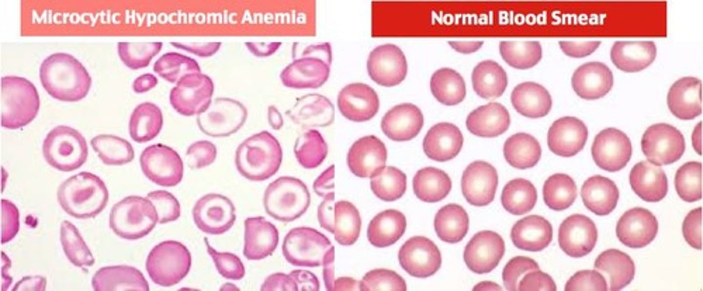 <p>Microcytic hypochromic anemia.</p>