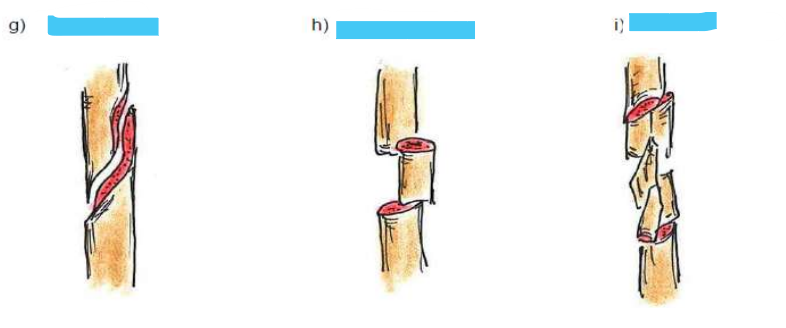 <p>Knochenbruchformen</p>