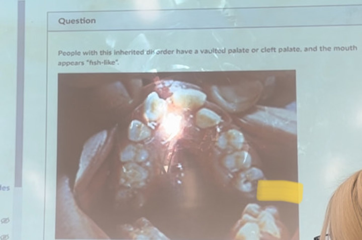 <p>People with this inherited disorder have a vaulted palate or cleft palate, and the mouth appears "fish-like"</p>