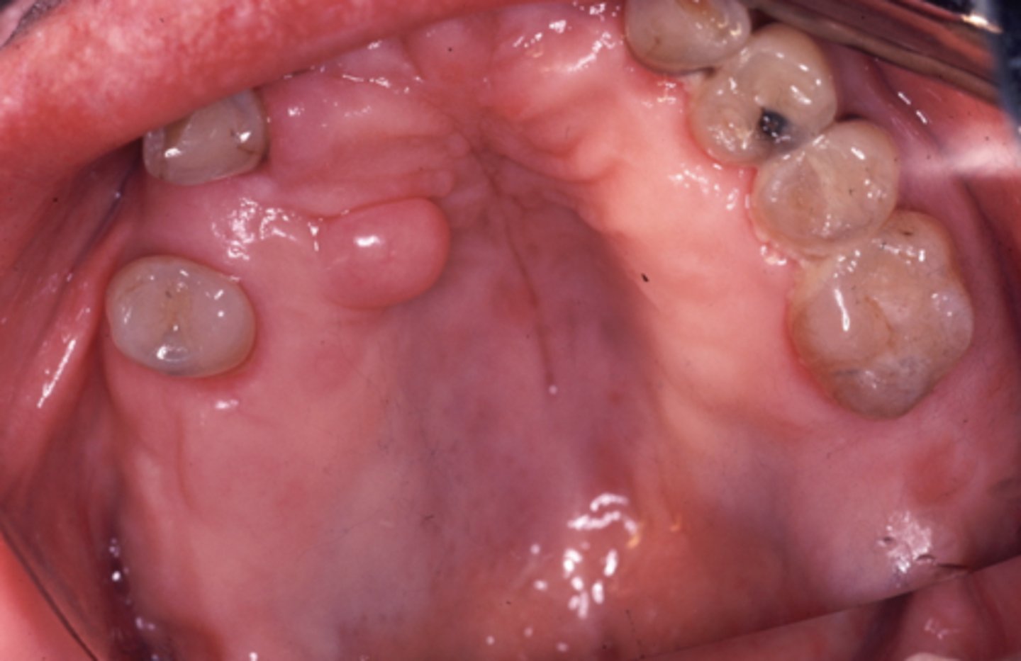<p>smooth surface, non-ulcerated</p>