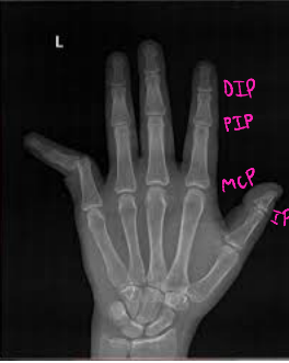 <p><strong>Finger Dislocations</strong></p><p>-Types</p><ul><li><p>MCP, ___, DIP</p></li></ul><p>-Classification → based on the location of the ______ bone in relationship to the proximal</p><ul><li><p>Dorsal, _____, lateral</p></li></ul><p></p>
