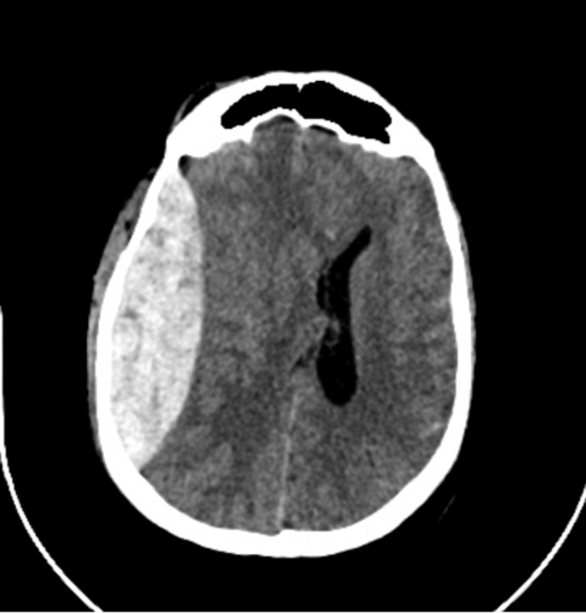 <p>intracranial bleeding, stroke (ischemic or hemorrhagic), brain/spine tumors, fractures, spinal stenosis </p>