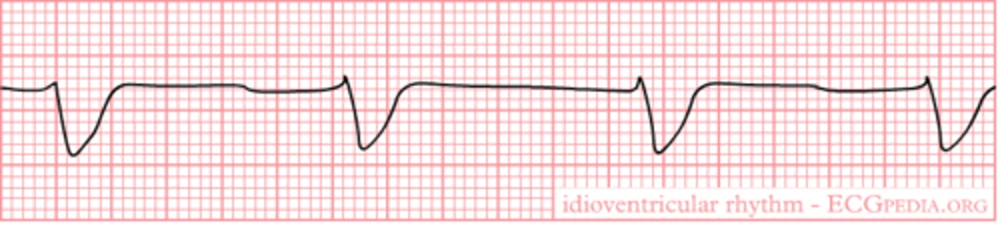 <p>Idioventricular rhythm</p>