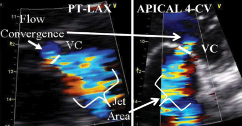 <p>When looking at the colour Doppler cineloop of the MR, cineloop through to systole where the MR occurs. Zoom this area and measure the area right below the PISA shell.</p>