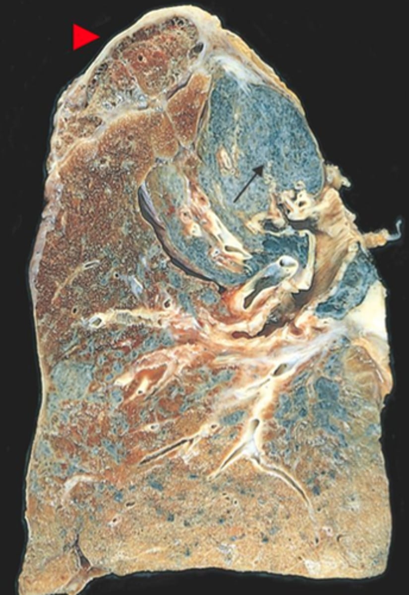 <p>silicosis</p>