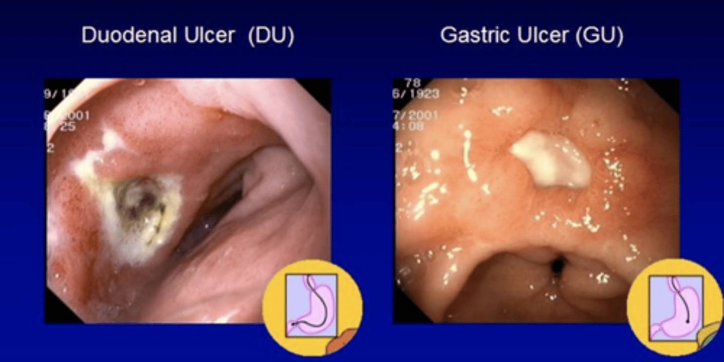 <p>1.) Endoscopy with biopsy.</p><p>2.) Peptic Ulcer --&gt; Since symptoms improve after eating this is specifically a duodenal ulcer</p><p>3.) PPIs and H2RAs</p><p>- Mucosal defense agents such as bismuth sucralfate or misoprostol</p>