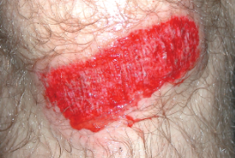 <p><span>Skin lesion with loss of epidermis</span></p>