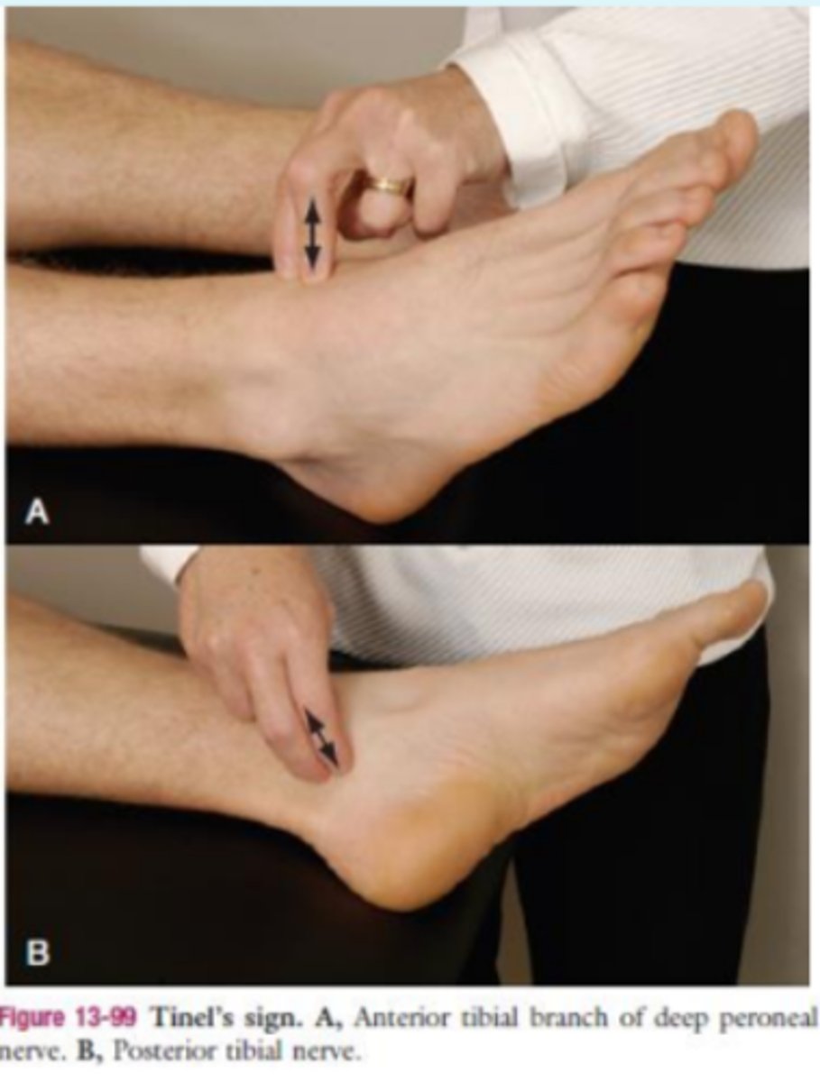 <p>- dysfunction of posterior tibial nerve</p><p>(+): tingling or paresthesia felt distally</p>
