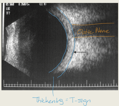 <p>The <strong>“T-sign”</strong>, caused by fluid in Tenon’s space; other findings include scleral thickening, nodules, separation of Tenon capsule, disc edema, choroidal folds, and retinal detachment.</p>